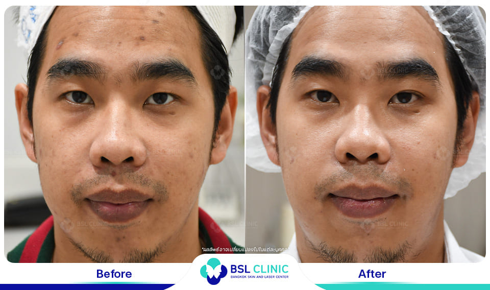 Skin-Brightening-and-Whitening-Treatment