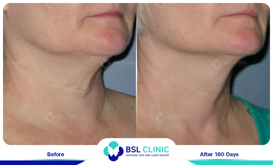 result-Facelift-Ulthera37