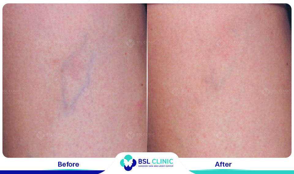 results-Sclerotherapy