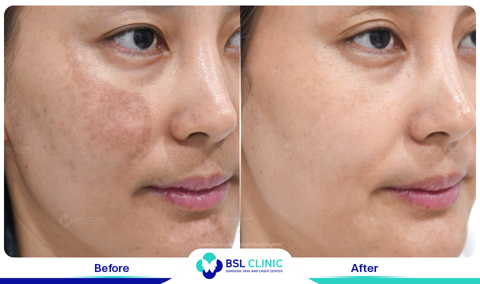 result melasma dark spot