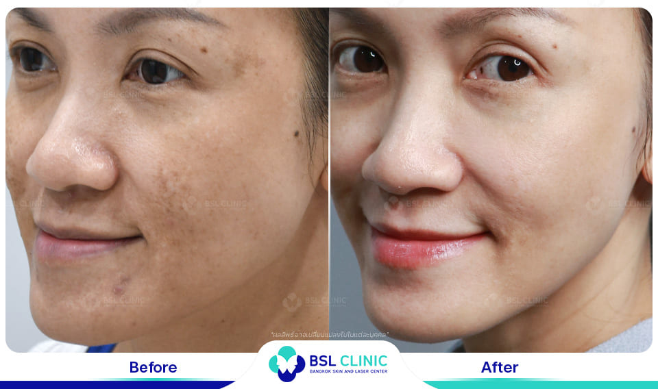 result melasma dark spot