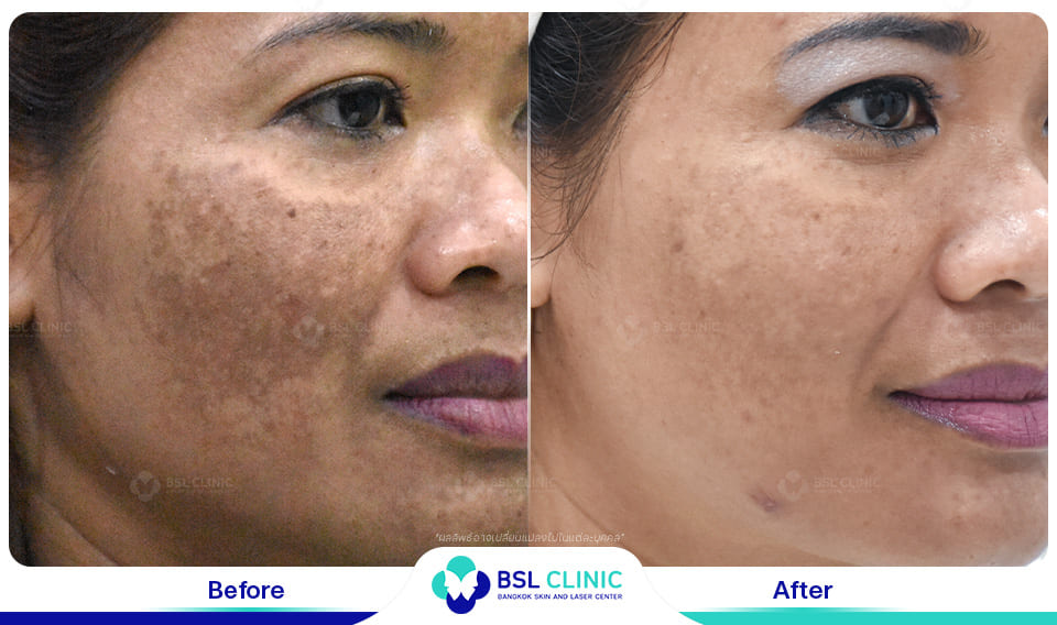 result melasma dark spot