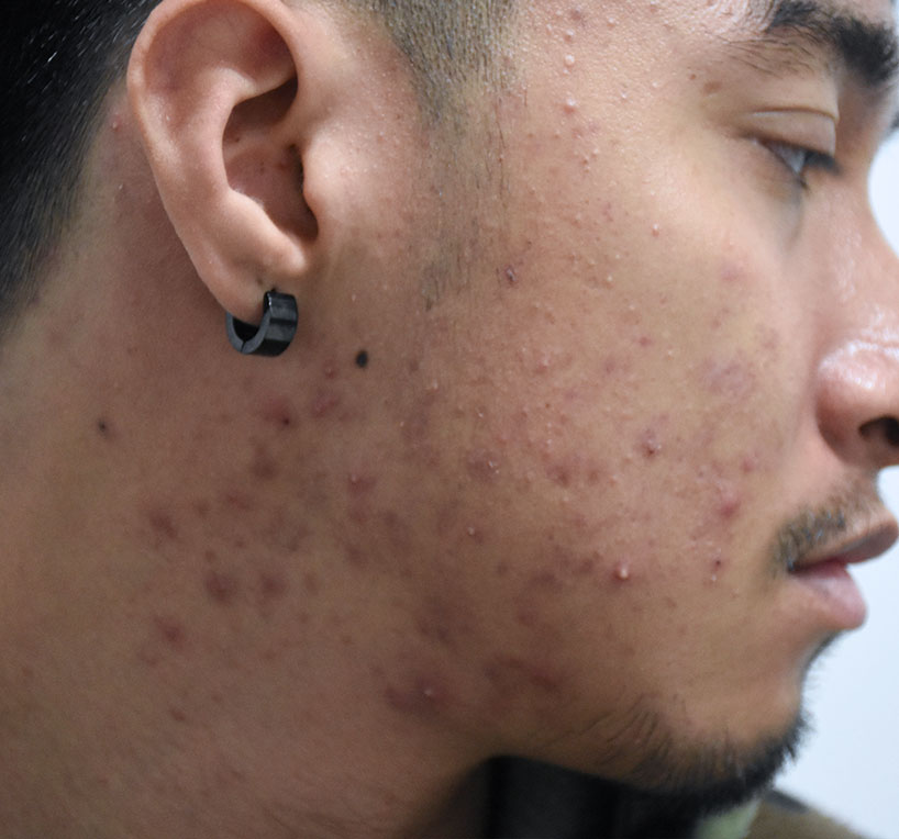 Acne-is-Treatable