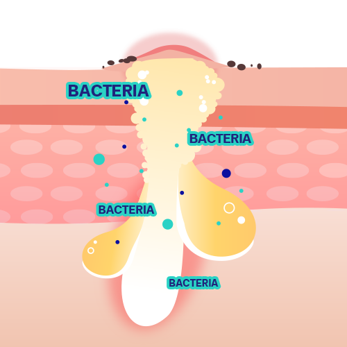 Bacteria-acne