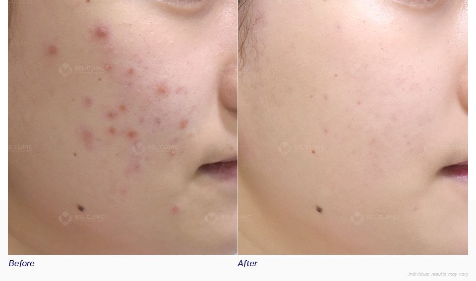 Before-After-Facial-Redness