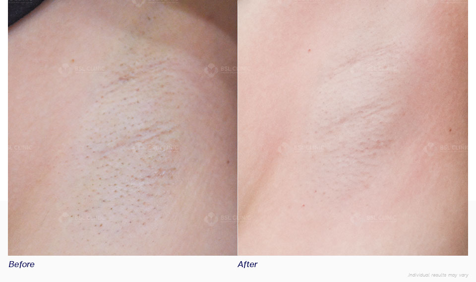 Before-After-Underarm-Brightening