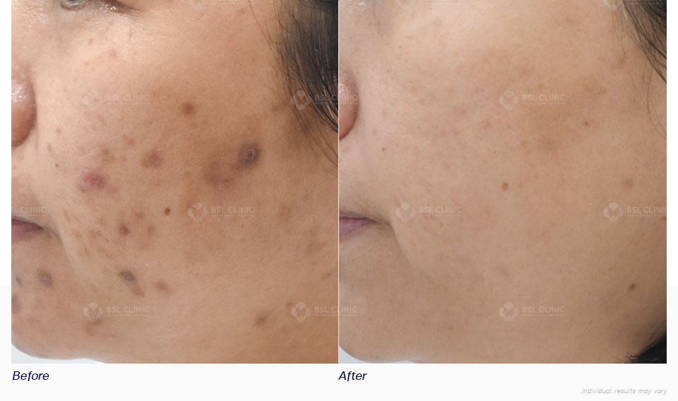 Before-After-dark-spot-whitening