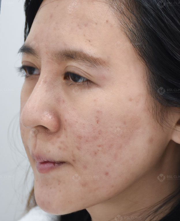 Before-acne-Treatment