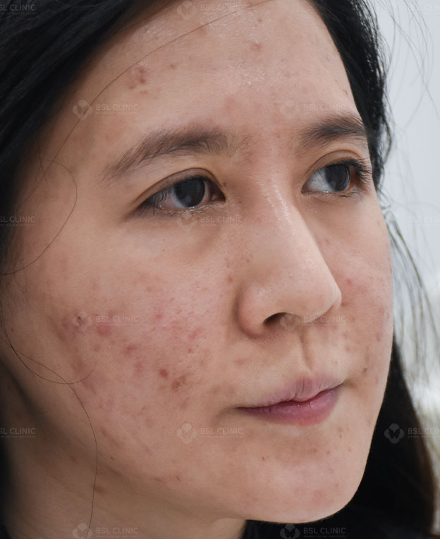 Before-acne-Treatment