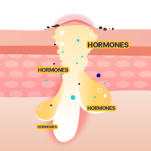 hormones-acne