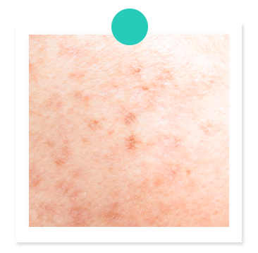 Freckles-dark-spot-sun-spot