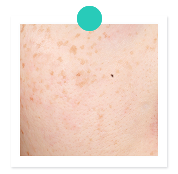 Freckles-dark-spot