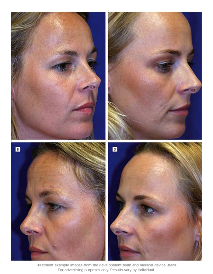 twin-study-anti-wrinkle-injection-forehead-crows-feet-long-term-results-02